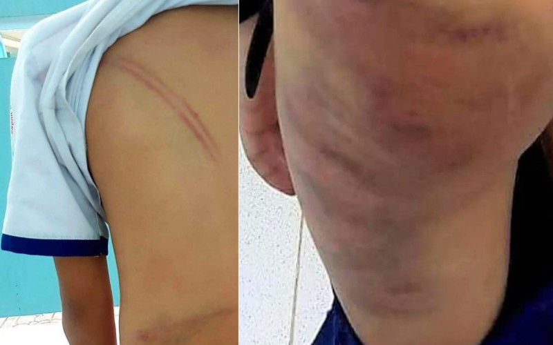 Vết bầm trên cơ thể bé T. Vết bầm trên cơ thể bé T.