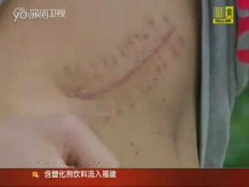 Cậu bé 17 tuổi ở tỉnh An Huy đã bán thận để mua iPad