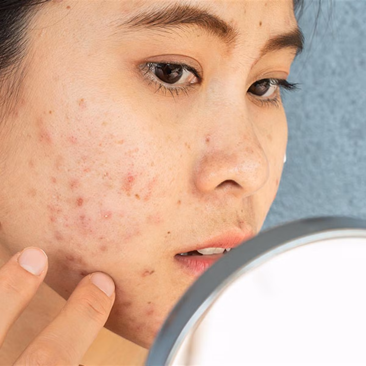 Ham mỹ phẩm rẻ, không rõ nguồn gốc có thể dẫn đến da bị dị ứng, lên mụn khó chữa.