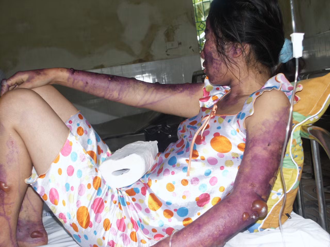 Chị Luyên bị bỏng nhẹ