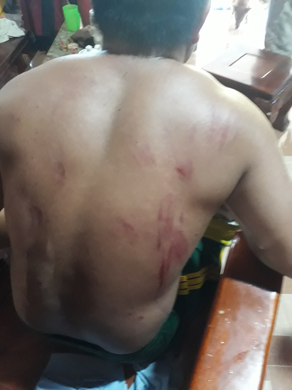 Ông L. bị đa chấn thương do voi tấn công