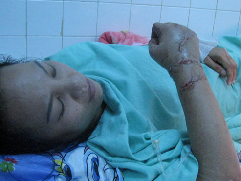 Bệnh nhân Nguyễn Thị Ngọc Thúy với bàn tay đã được nối liền tại Bệnh viện Chấn thương chỉnh hình. Ảnh: Ngọc Nga. Bệnh nhân Nguyễn Thị Ngọc Thúy với bàn tay đã được nối liền tại Bệnh viện Chấn thương chỉnh hình. Ảnh: Ngọc Nga