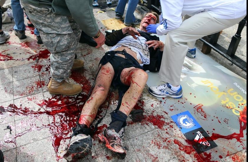 Vụ nổ bom khiến nhiều người bị thương nặng . Vụ nổ bom khiến nhiều người bị thương nặng