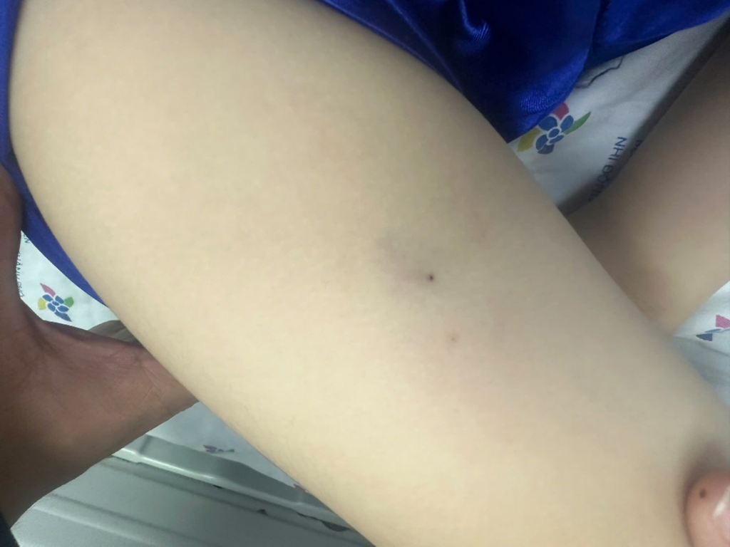 Vết đốt ong ruồi trên cơ thể của trẻ được bác sĩ xác định là nguyên nhân dẫn tới sốc phản vệ Vết đốt ong ruồi trên cơ thể của trẻ được bác sĩ xác định là nguyên nhân dẫn tới sốc phản vệ