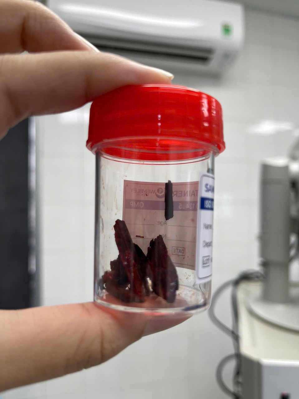 Dị vật là mảnh gỗ được các bác sĩ phẫu thuật lấy ra khỏi cơ thể người bệnh