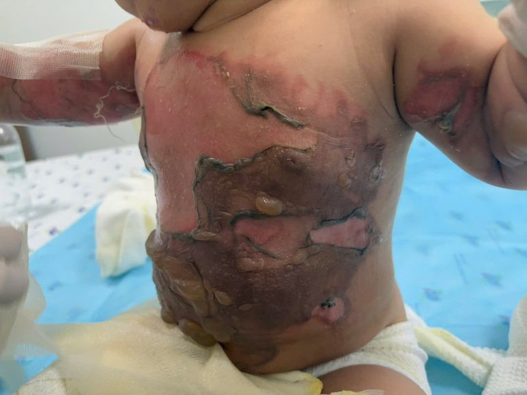 Vết bỏng thương tâm trên cơ thể bé T.L. do nồi chè đổ xuống người