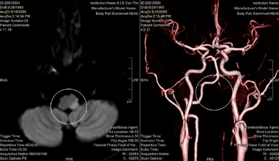 Vị trí bị tắc động mạch đốt sống bên trái khiến người bệnh bị nhồi máu não Vị trí bị tắc động mạch đốt sống bên trái khiến người bệnh bị nhồi máu não