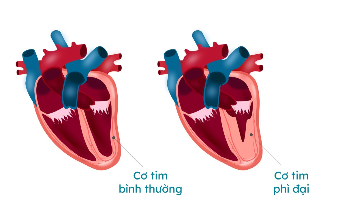 Bệnh lý cơ tim phì đại là nguyên nhân dẫn tới nguy cơ đột tử cho người bệnh Bệnh lý cơ tim phì đại là nguyên nhân dẫn tới nguy cơ đột tử cho người bệnh