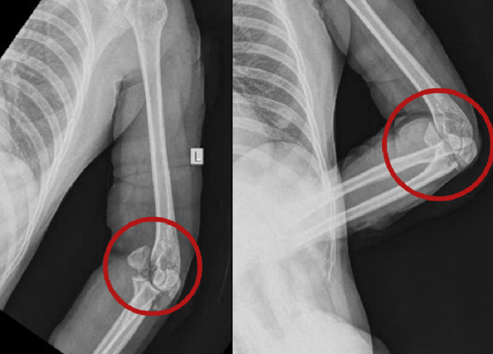 Những nhát chém chí mạng khiến nạn nhân bị vỡ xương khuỷu tay (khu vực khoanh tròn) Những nhát chém chí mạng khiến nạn nhân bị vỡ xương khuỷu tay (khu vực khoanh tròn)