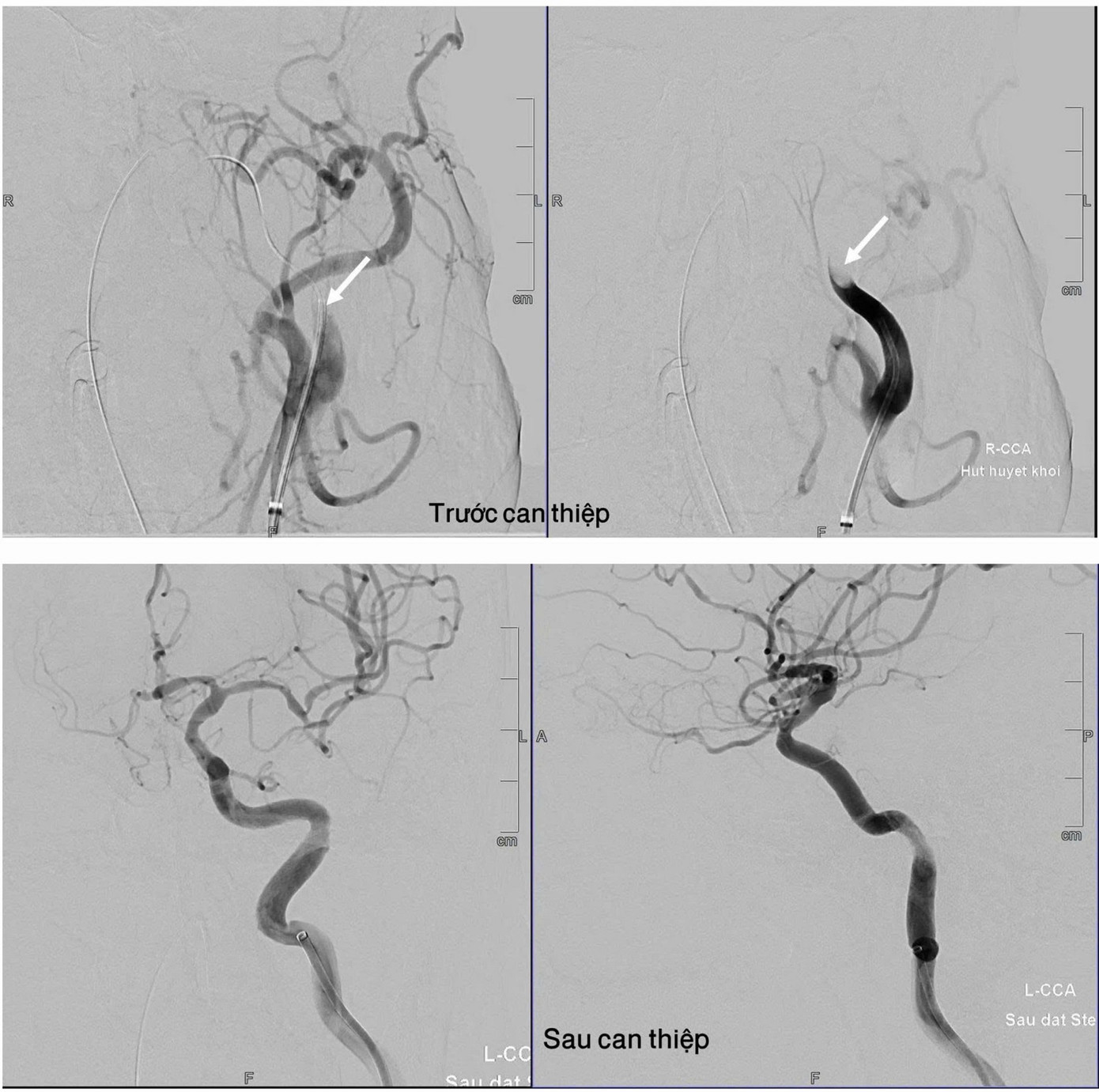 Hình ảnh động mạch của bệnh nhân trước và sau khi được các bác sĩ can thiệp Hình ảnh động mạch của bệnh nhân trước và sau khi được các bác sĩ can thiệp