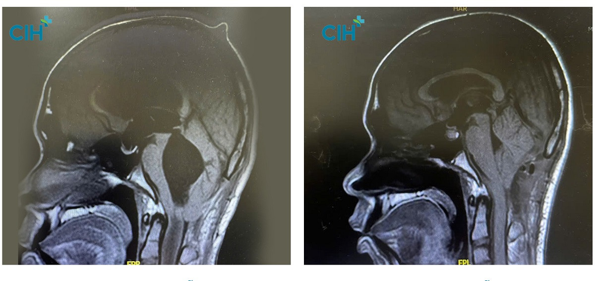 Hình ảnh chụp MRI vùng đầu của bệnh nhân trước và sau phẫu thuật Hình ảnh chụp MRI vùng đầu của bệnh nhân trước và sau phẫu thuật