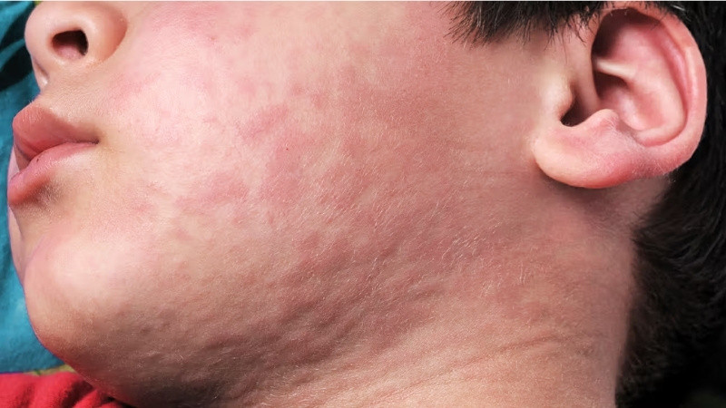 Nổi mề đay là một trong những dấu hiệu cảnh báo về tình trạng phản vệ