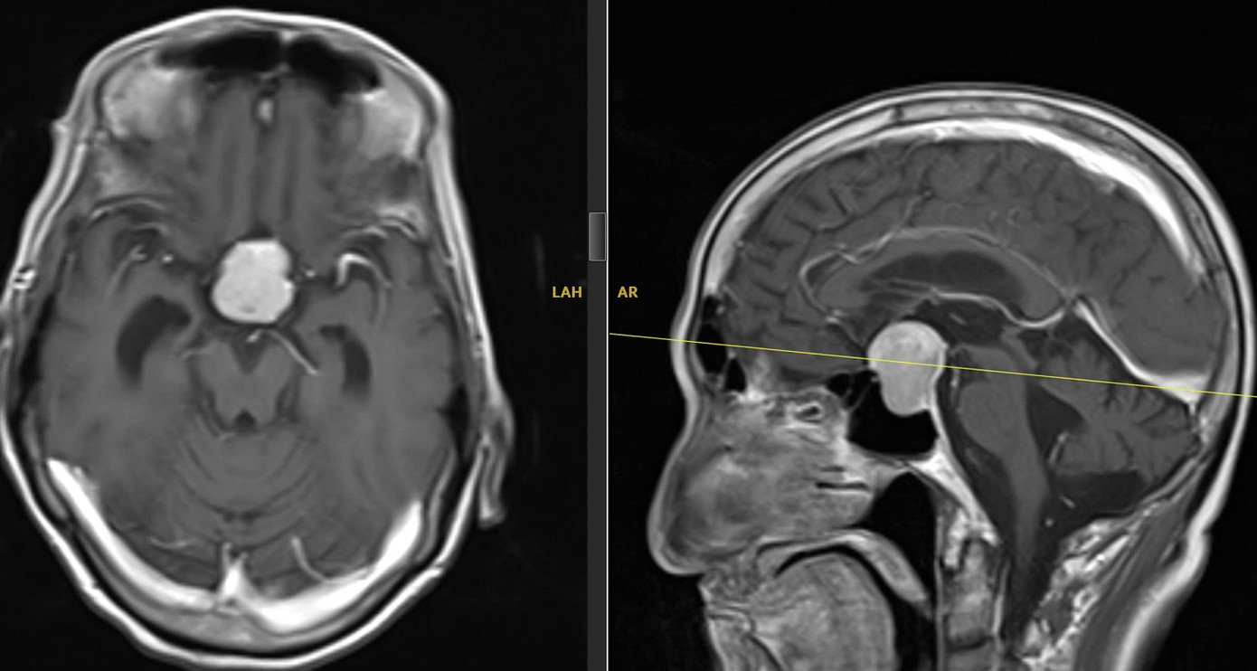 Khối u tuyến yên (vùng màu trắng) là nguyên nhân khiến người bệnh mờ mắt, đau đầu Khối u tuyến yên (vùng màu trắng) là nguyên nhân khiến người bệnh mờ mắt, đau đầu
