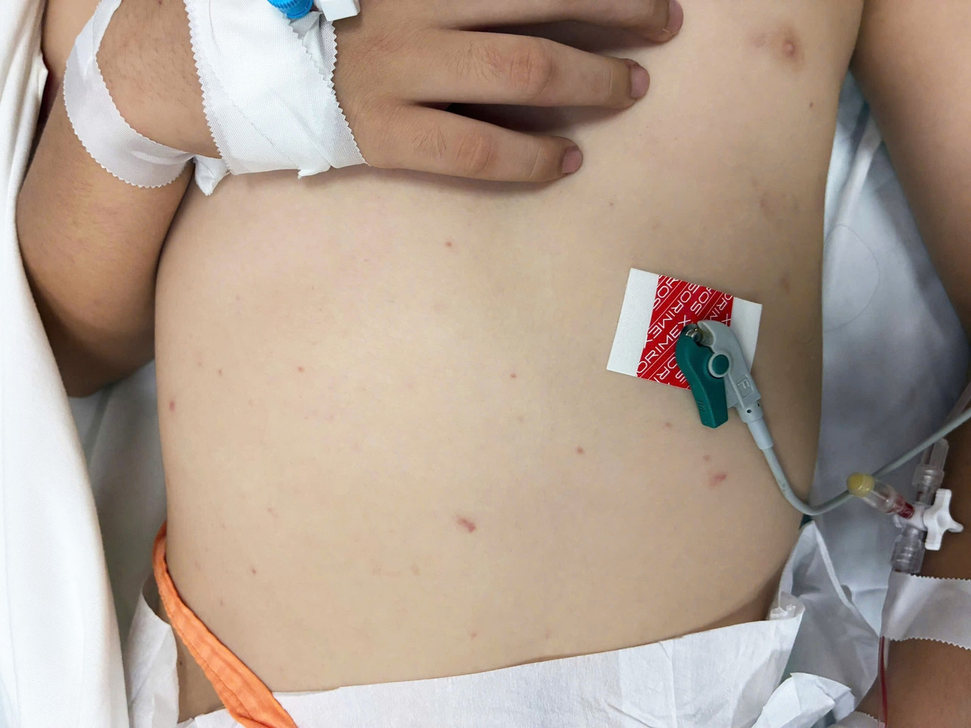 Bệnh nhi nhập viện trong tình trạng viêm màng não, sốt cao, đau đầu dữ dội Bệnh nhi nhập viện trong tình trạng viêm màng não, sốt cao, đau đầu dữ dội