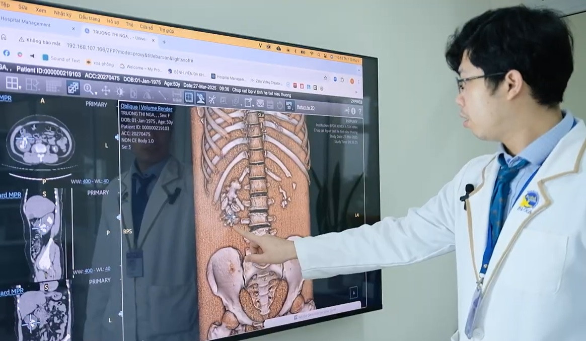 Bác sĩ chỉ ra tình trạng sỏi san hô nghiêm trọng bệnh nhân đang gặp phải Bác sĩ chỉ ra tình trạng sỏi san hô nghiêm trọng bệnh nhân đang gặp phải