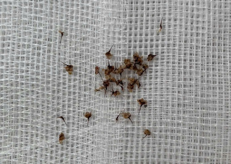 Ngòi ong đốt được các bác sĩ gắp ra khỏi cơ thể bệnh nhân Ngòi ong đốt được các bác sĩ gắp ra khỏi cơ thể bệnh nhân