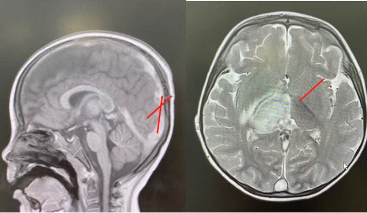 Kết quả kiểm tra hình ảnh cho thấy huyết khối và tình trạng tổn thương não ở bệnh nhi (ảnh: BVCC) Kết quả kiểm tra hình ảnh cho thấy huyết khối và tình trạng tổn thương não ở bệnh nhi (ảnh: BVCC)