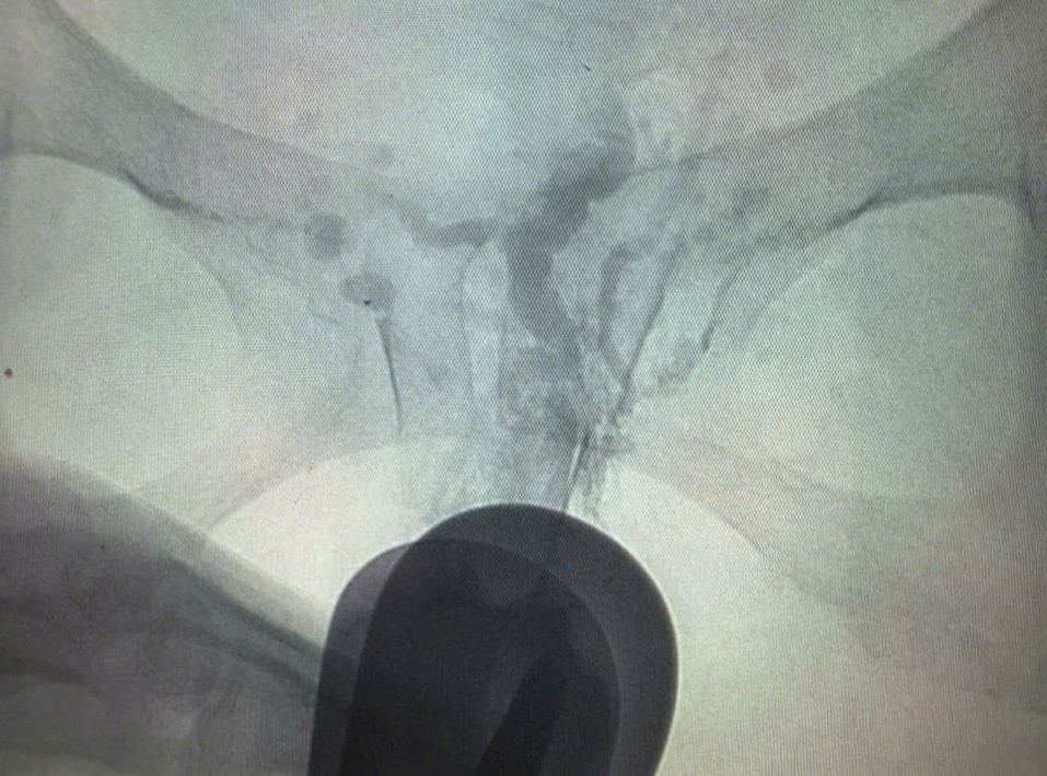 Vị trí mạch máu dị dạng của bệnh nhân trên hình ảnh X-quang xóa nền Vị trí mạch máu dị dạng của bệnh nhân trên hình ảnh X-quang xóa nền