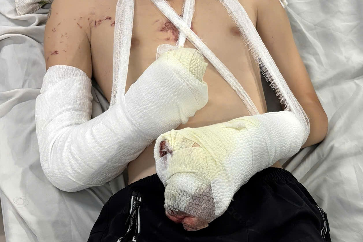 Chỉ vì thiếu hiểu biết, chàng trai trẻ đã vĩnh viễn mất một bàn tay, rơi vào cảnh tàn phế Chỉ vì thiếu hiểu biết, chàng trai trẻ đã vĩnh viễn mất một bàn tay, rơi vào cảnh tàn phế