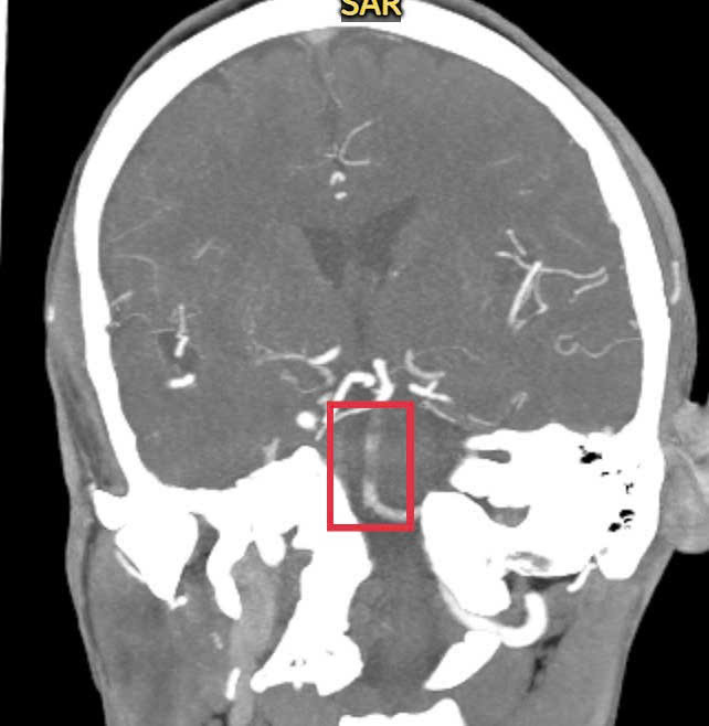 Hình ảnh kiểm tra ghi nhận bệnh nhân bị đột quỵ do tắc động mạch thân nền Hình ảnh kiểm tra ghi nhận bệnh nhân bị đột quỵ do tắc động mạch thân nền