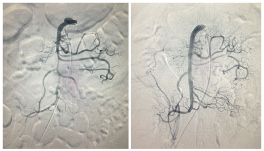 Hệ thống động mạch treo tràng trên của người bệnh trước và sau khi can thiệp Hệ thống động mạch treo tràng trên của người bệnh trước và sau khi can thiệp