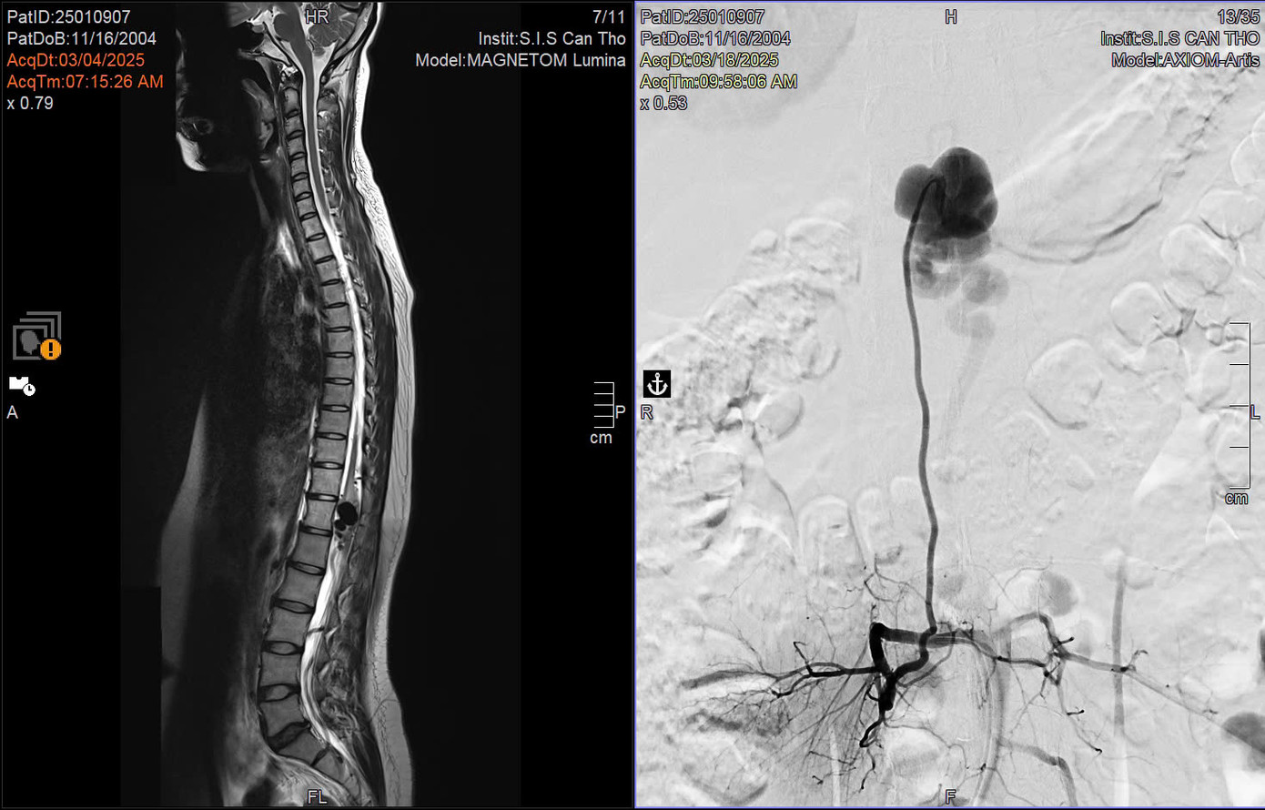 Hình ảnh kiểm tra phát hiện vị trí dị dạng mạch máu tủy ở bệnh nhân Hình ảnh kiểm tra phát hiện vị trí dị dạng mạch máu tủy ở bệnh nhân