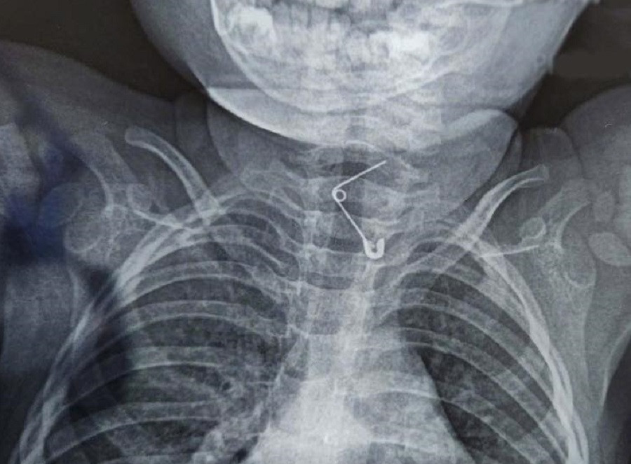 Bệnh nhi đã bị chiếc kim băng ghim vào thực quản sau khi người lớn cố dùng tay móc dị vật Bệnh nhi đã bị chiếc kim băng ghim vào thực quản sau khi người lớn cố dùng tay móc dị vật