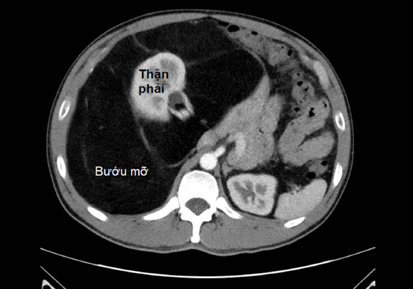 Hình ảnh kiểm tra ghi nhận khối bướu mỡ khổng lồ chiếm gần hết ổ bụng bệnh nhân