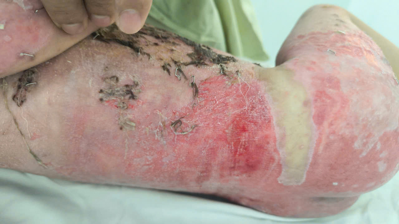 Cơ thể bệnh nhi bị bỏng với diện tích lên đến 60% đe dọa trực tiếp đến tính mạng