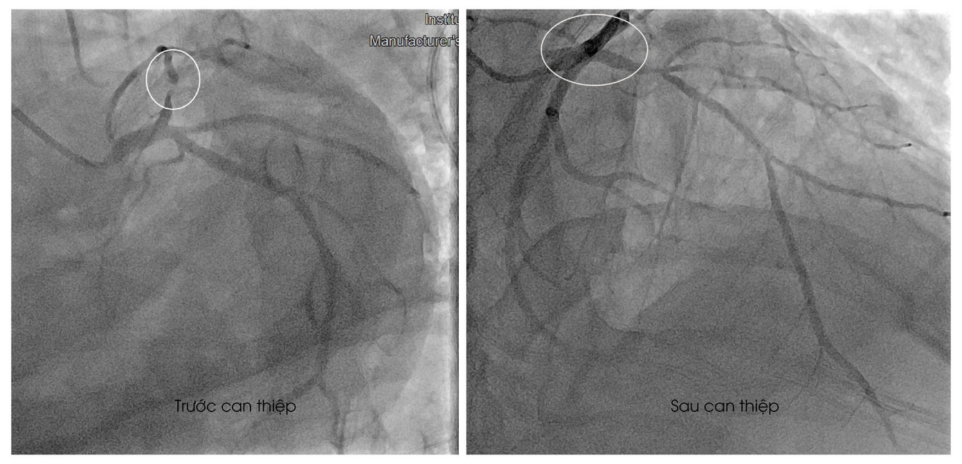 Hình ảnh mạch máu của bệnh nhân bị tắc trước và sau can thiệp
