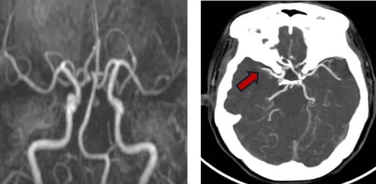 Hình ảnh mạch máu của bệnh nhân được tái thông nhờ thuốc tiêu sợi huyết nhưng sau đó lại bị tắc nghẽn bởi cục máu đông ở lần đột quỵ thứ hai (ảnh: BVCC)