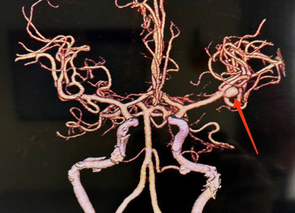 Hình ảnh kiểm tra cho thấy người bệnh bị vỡ túi phình mạch máu não