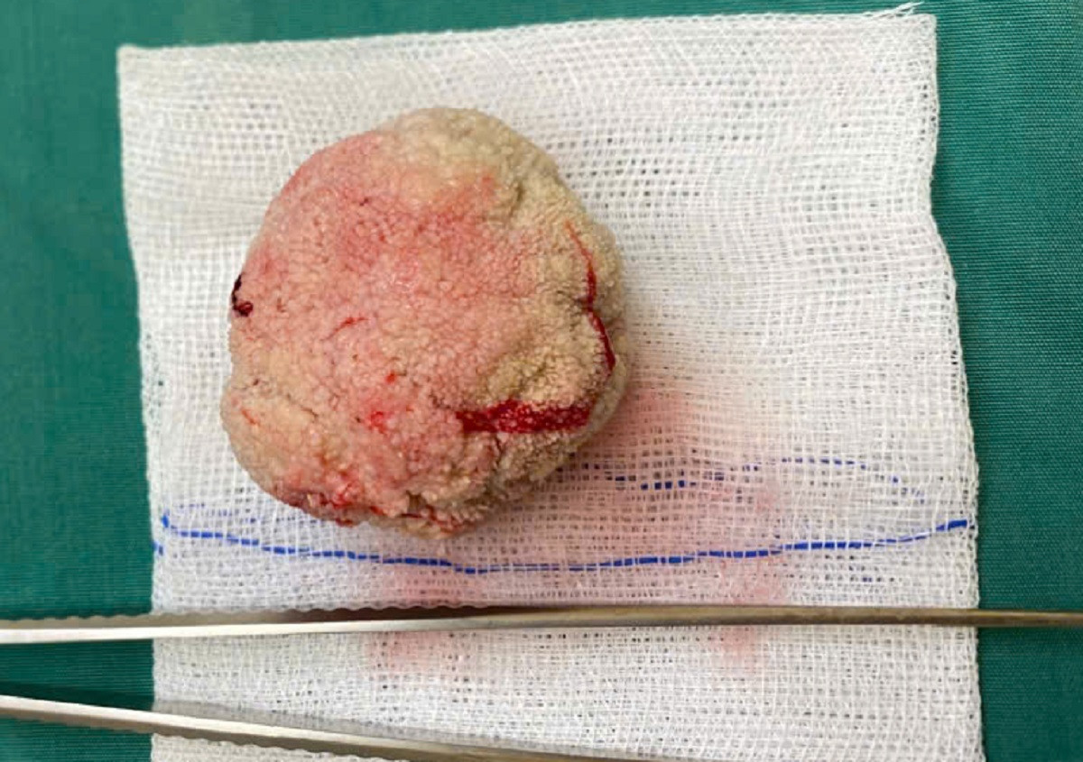 Viên sỏi bàng quang có kích thước lớn như quả trứng gà được các bác sĩ lấy ra khỏi cơ thể người bệnh