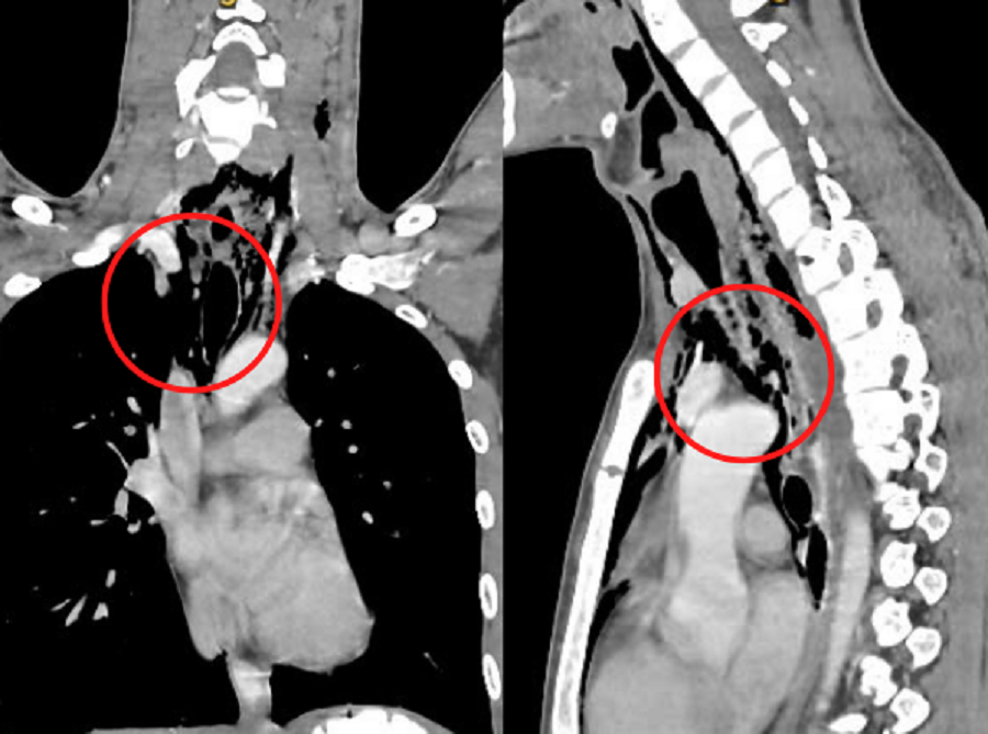 Hình ảnh kiểm tra cho thấy vị trí thực quản bị lưỡi kiếm đâm thủng (khu vực khoanh tròn)