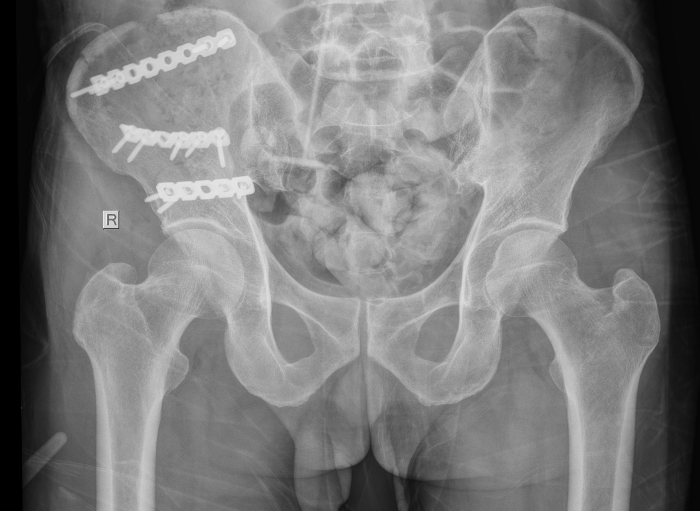 Cú té từ nóc nhà xuống đất khiến bệnh nhân bị gãy nhiều xương khắp cơ thể