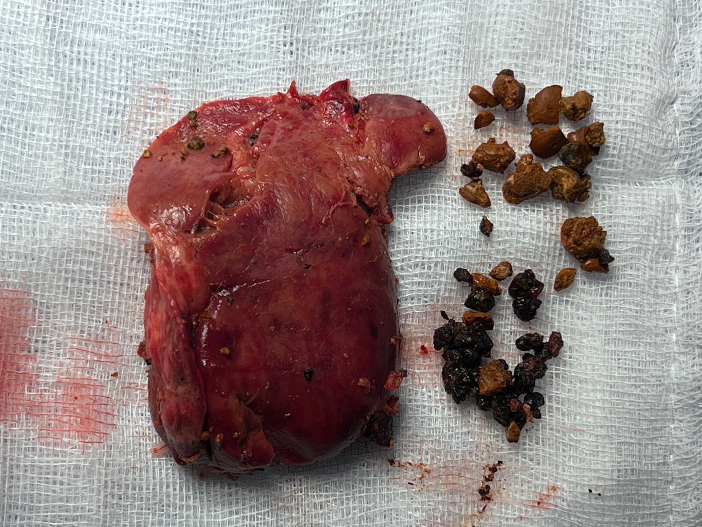 Rất nhiều viên sỏi đã được lấy ra trong thùy gan đã bị xơ của người bệnh