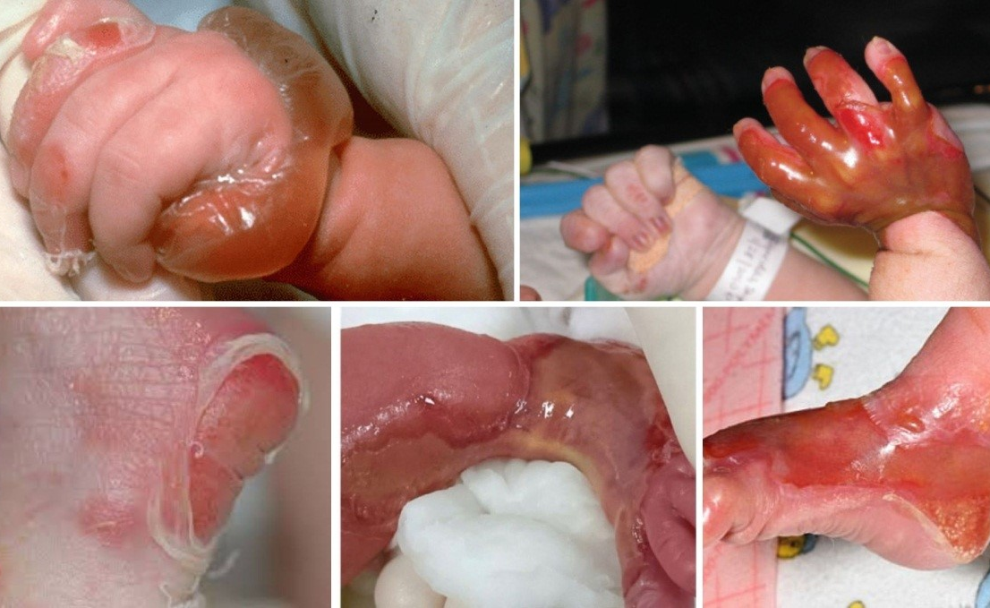 Tình trạng tổn thương trên da ở trẻ ngay sau khi chào đời (ảnh: BVCC) Tình trạng tổn thương trên da ở trẻ ngay sau khi chào đời (ảnh: BVCC)
