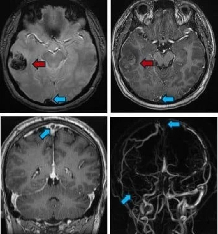 Bệnh nhân bị xuất huyết não vùng thái dương phải (mũi tên đỏ); huyết khối xoang tĩnh mạch dọc trên, xoang ngang – xoang sigma, tĩnh mạch vỏ não đính 2 bên (mũi tên xanh) Bệnh nhân bị xuất huyết não vùng thái dương phải (mũi tên đỏ); huyết khối xoang tĩnh mạch dọc trên, xoang ngang – xoang sigma, tĩnh mạch vỏ não đính 2 bên (mũi tên xanh)