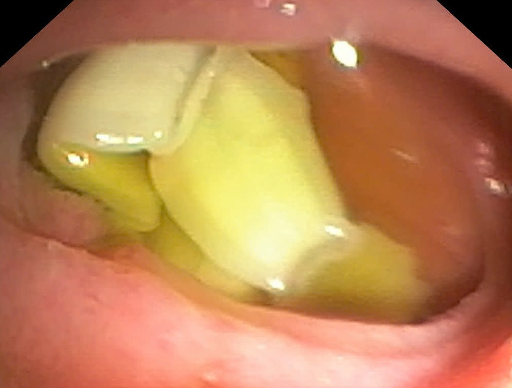 Hình ảnh nội soi phát hiện sán dây ký sinh trong đường tiêu hóa của người bệnh Hình ảnh nội soi phát hiện sán dây ký sinh trong đường tiêu hóa của người bệnh