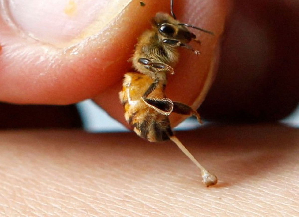 Bác sĩ cảnh báo việc điều trị ung thư bằng các phương pháp đắp lá, cho ong đốt sẽ khiến tình trạng bệnh trở nặng