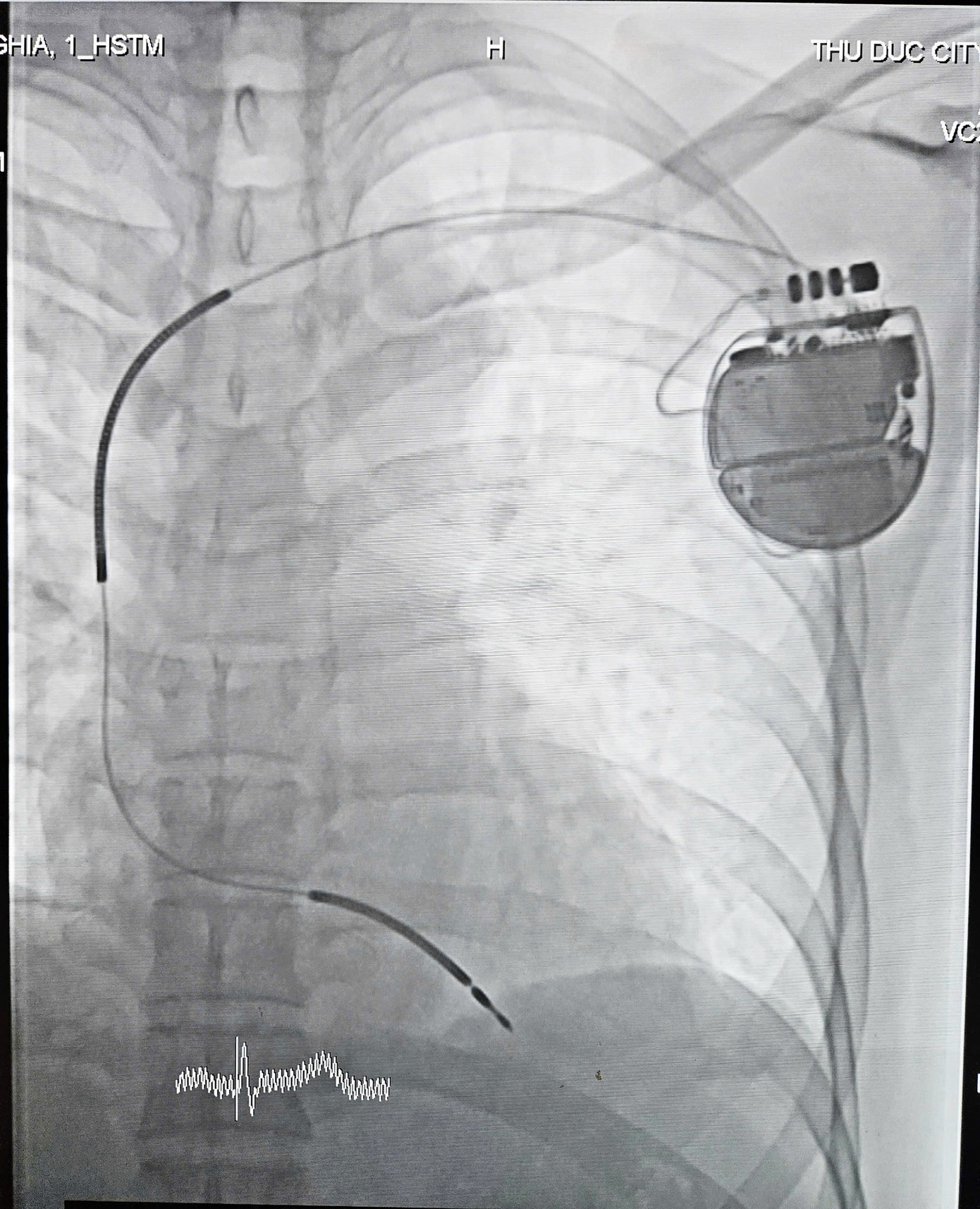 Thiết bị được đặt dưới da có khả năng kiểm soát nguy cơ rối loạn nhịp thất cho bệnh nhân Thiết bị được đặt dưới da có khả năng kiểm soát nguy cơ rối loạn nhịp thất cho bệnh nhân