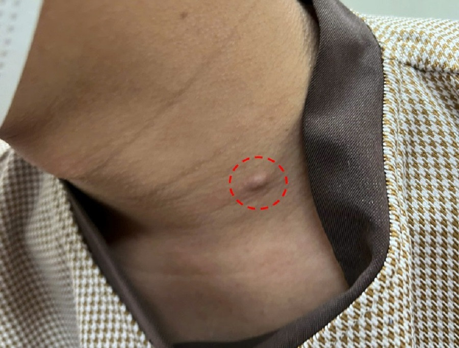 Cục mụn trên cổ lâu năm của người bệnh được bác sĩ xác định là khối u ung thư da Cục mụn trên cổ lâu năm của người bệnh được bác sĩ xác định là khối u ung thư da