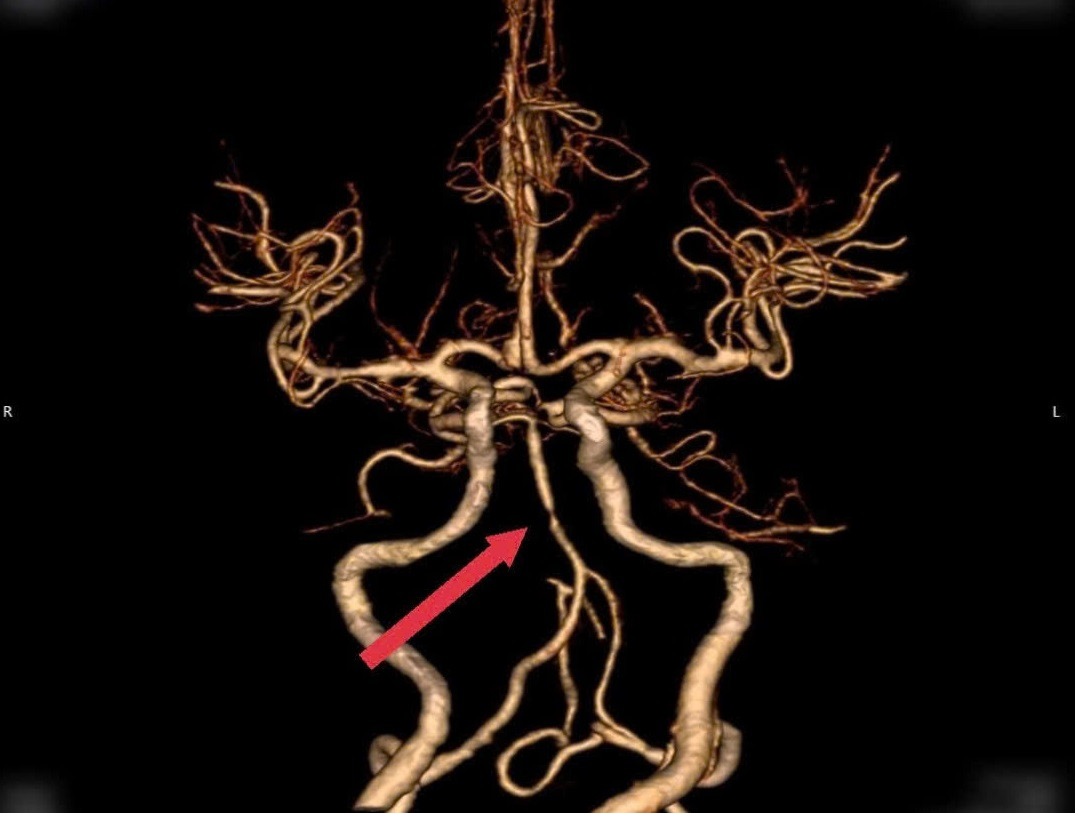 Hình ảnh kiểm tra xác định vị trí mạch máu não của bà N. bị tắc khiến bệnh nhân bị đột quỵ Hình ảnh kiểm tra xác định vị trí mạch máu não của bà N. bị tắc khiến bệnh nhân bị đột quỵ