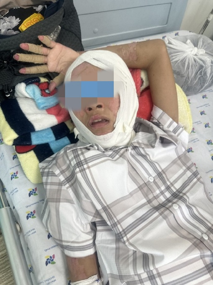 Sau khi được điều trị tích cực, bệnh nhi đã qua nguy kịch sức khỏe dần bình phục nhưng di chứng bỏng sẽ ảnh hưởng xấu đến chất lượng sống