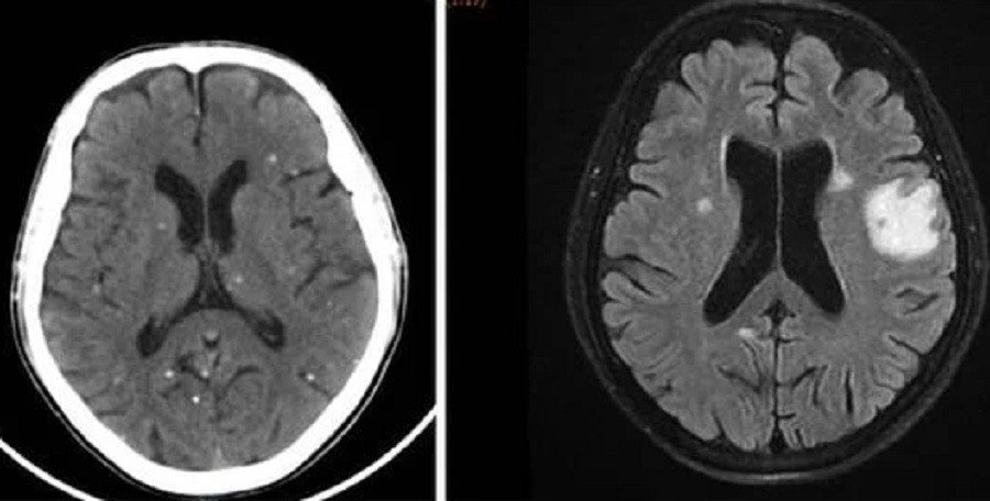 Nang sán dải ký sinh ở bán cầu não hai bên là nguyên nhân khiến người bệnh bị tổn thương não, biểu hiện như đột quỵ Nang sán dải ký sinh ở bán cầu não hai bên là nguyên nhân khiến người bệnh bị tổn thương não, biểu hiện như đột quỵ