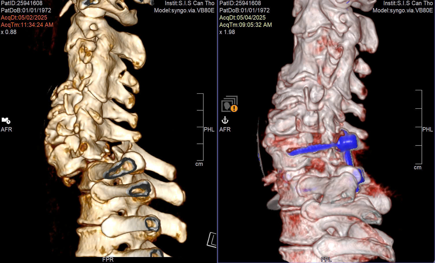 Vị trí đốt sống cổ của bệnh nhân bị gãy trước và sau phẫu thuật