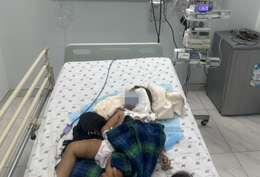 Bé G.H. bị bỏng nặng 42% diện tích cơ thể do bình nước sôi đổ xuống người