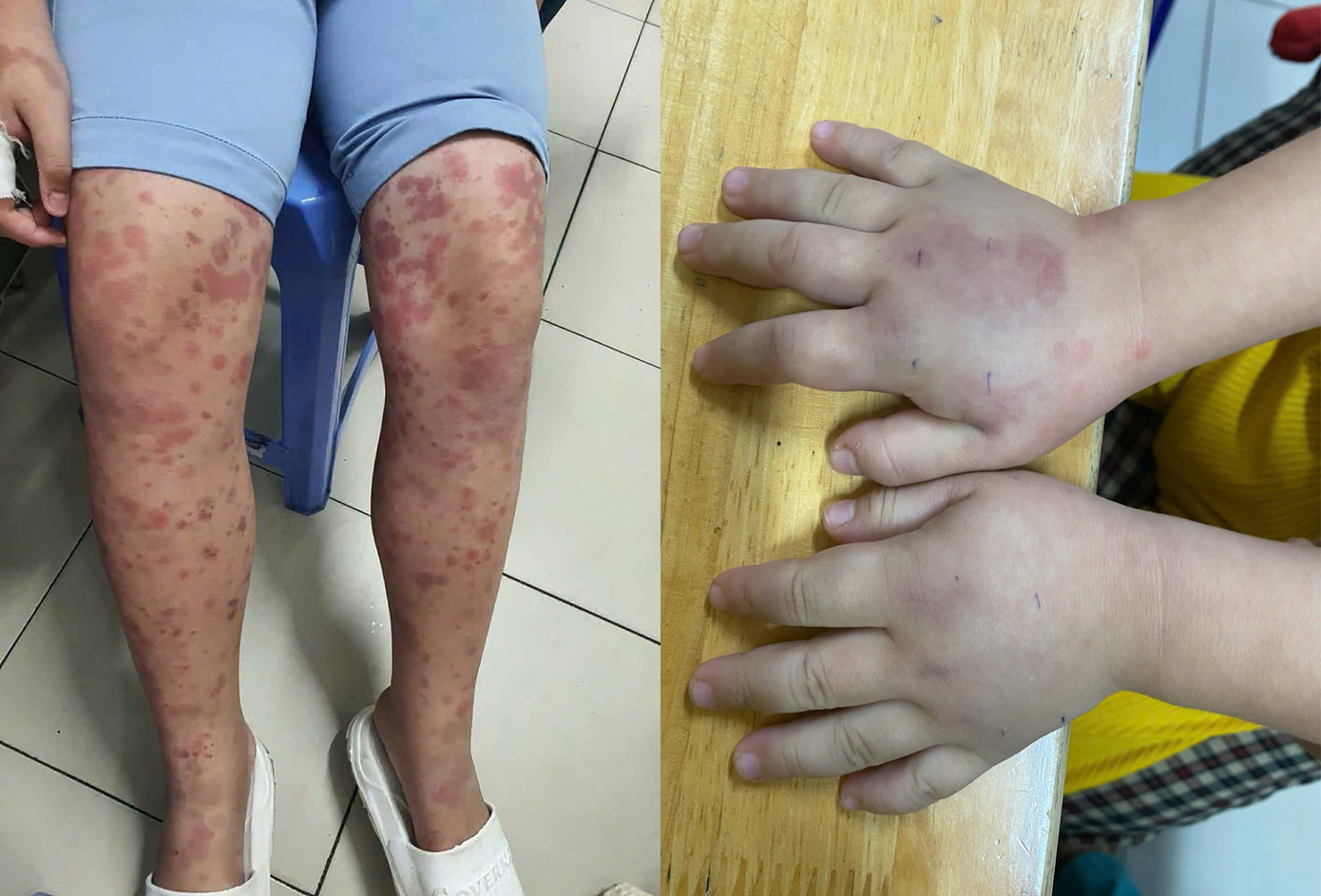 Biểu hiện của viêm mạch máu hệ thống ở trẻ rất dễ nhầm lẫn với các bệnh lý khác Biểu hiện của viêm mạch máu hệ thống ở trẻ rất dễ nhầm lẫn với các bệnh lý khác