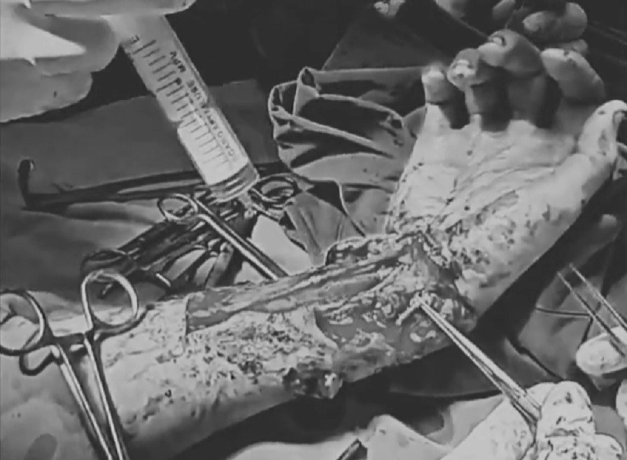 Vùng cổ tay của bệnh nhi bị kính sắc nhọn cắt nát, tổn thương nghiêm trọng Vùng cổ tay của bệnh nhi bị kính sắc nhọn cắt nát, tổn thương nghiêm trọng