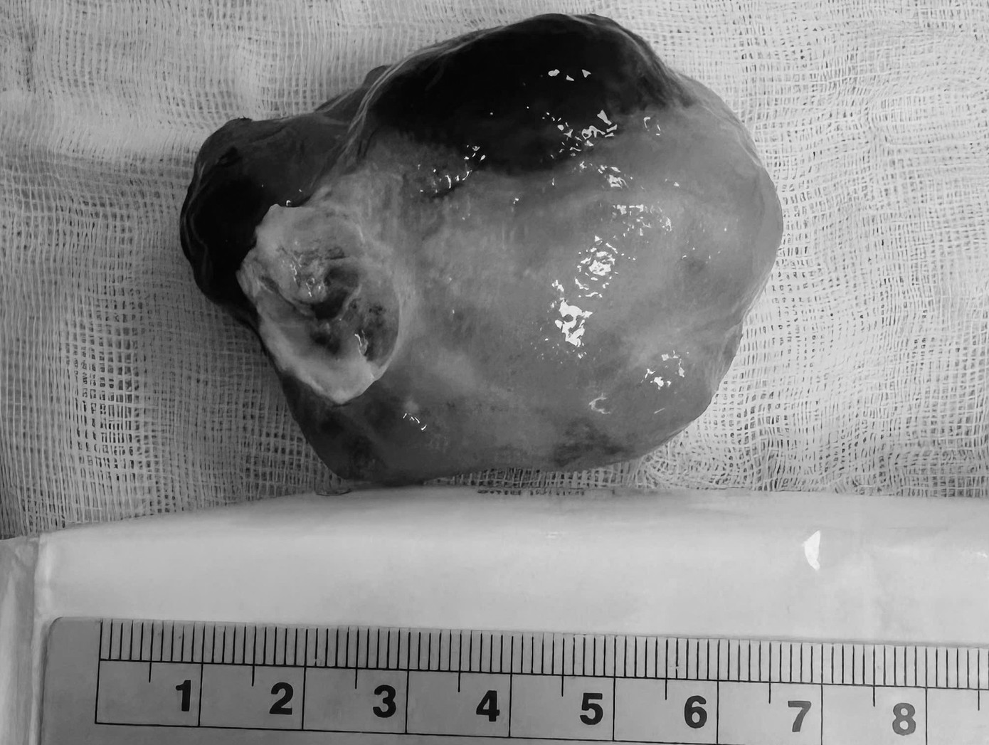 Khối u nhầy trong tim người bệnh được các bác sĩ cắt hoàn toàn khỏi cơ thể người bệnh Khối u nhầy trong tim người bệnh được các bác sĩ cắt hoàn toàn khỏi cơ thể người bệnh